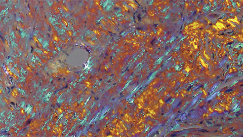 A microscopic sample of heart tissue treated with a dye called Congo red shows deposits of amyloid protein in apple green. There is growing medical appreciation that amyloid diseases affect tissues beyond the brain.