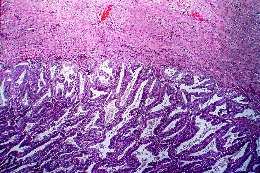 Endometrial-cancer-890x593.jpg