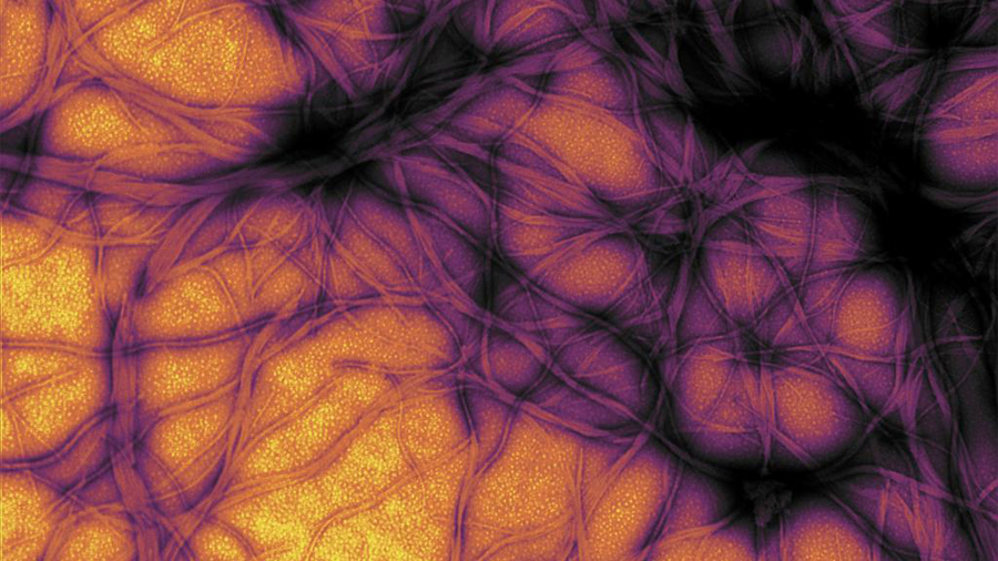 Before we’ve lost what we can’t rebuild: Hope for prion disease