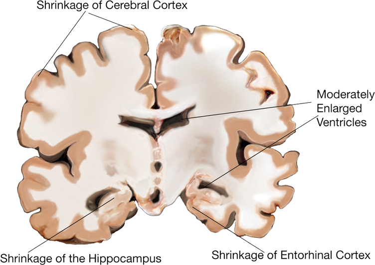 brain scan: moderate affliction