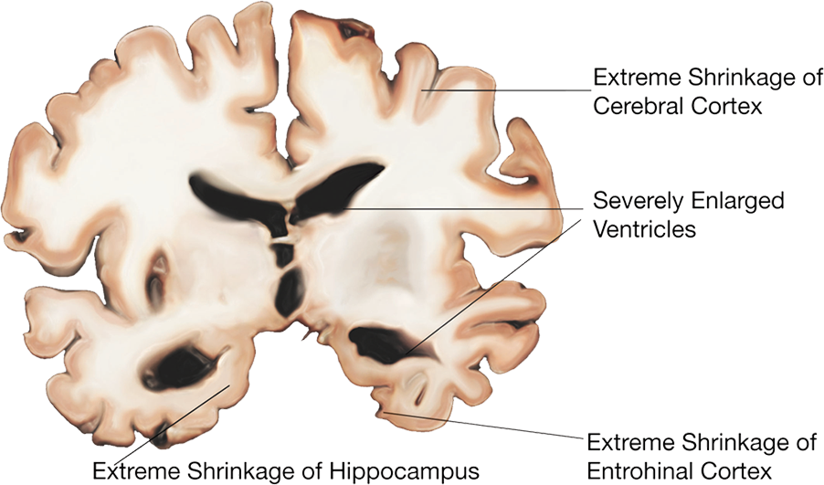 brain scan: severe affliction