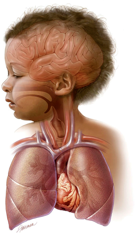 systems of pneumococcal infection