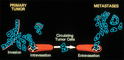 Metastasis illustration