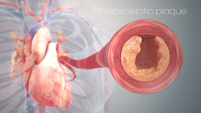 Atherosclerotic plaque