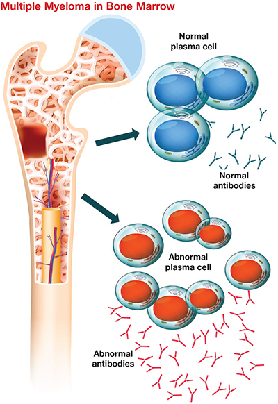 Plasma cells in bone marrow
