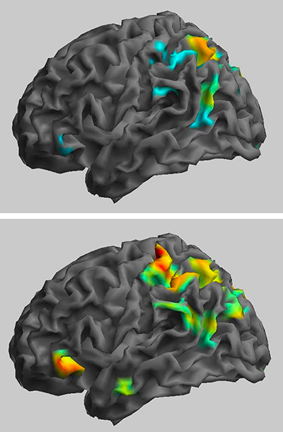 Ketamine appears to strengthen connections between neural networks in people with severe depression.