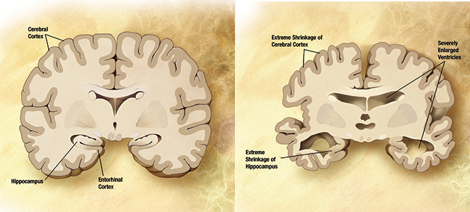 Alzheimer’s disease brain comparison