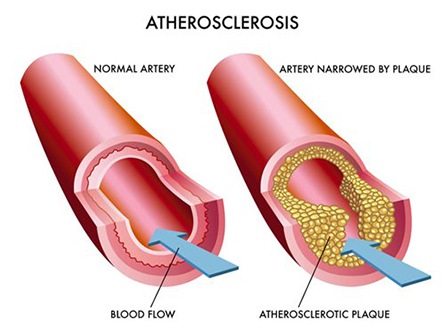 Atherosclerosis-445x334.jpg