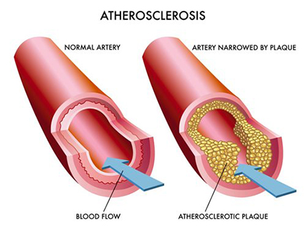 Atherosclerosis-445x334.jpg Atherosclerosis-445x334.jpg