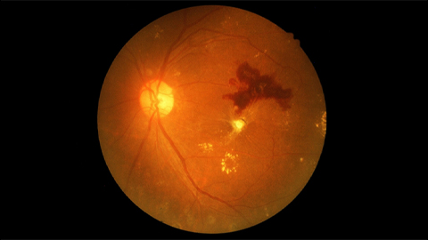 ‘Fatty retina’: A root cause of vision loss in diabetes?