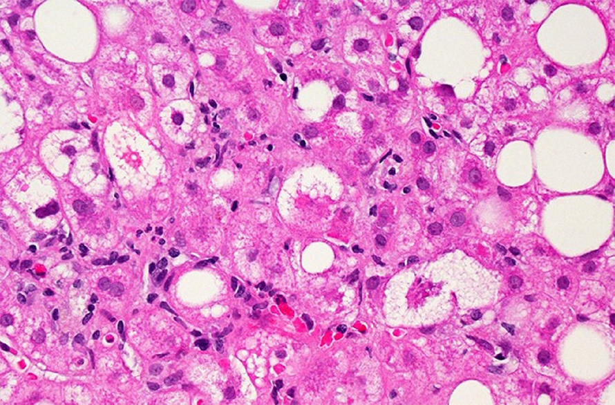 FattyLiverDisease-890x586.jpg FattyLiverDisease-890x586.jpg