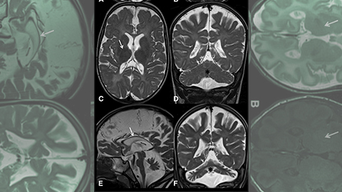 JLR: Medical detectives, linked by a PubMed search