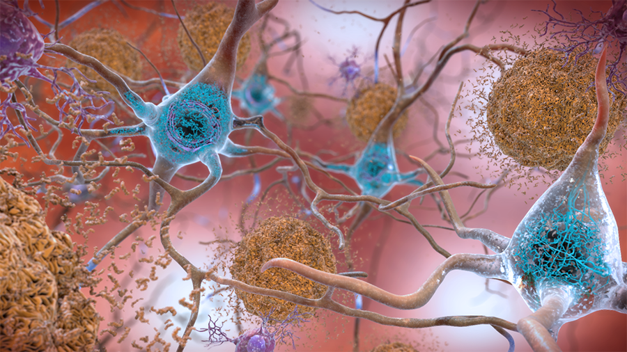 CRISPR nanoparticles are the next big hope in Alzheimer’s disease treatments