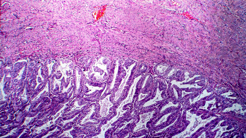 Researchers find potential new target for endometrial cancers