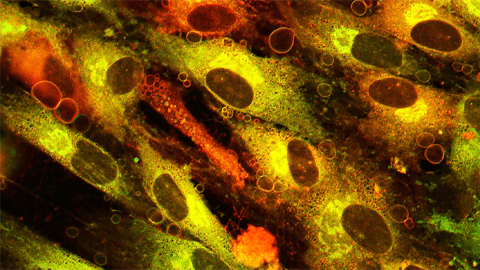 Ceramides’ role in liver disease