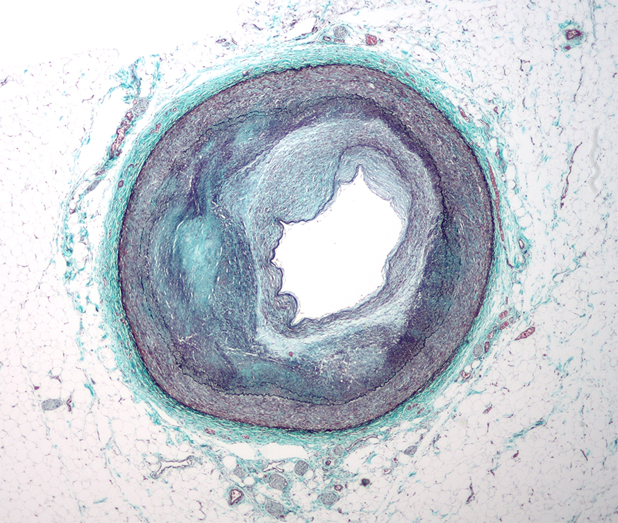 RCA_atherosclerosis-890x753.jpg RCA_atherosclerosis-890x753.jpg