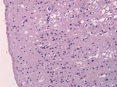 CJD_Cortical_spongiosis-445x330.jpg CJD_Cortical_spongiosis-445x330.jpg