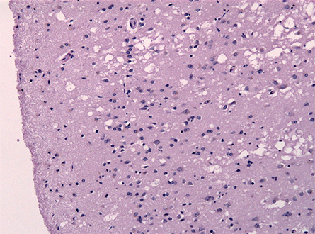 CJD_Cortical_spongiosis-445x330.jpg