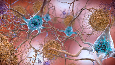 CRISPR nanoparticles are the next big hope in Alzheimer’s disease treatments