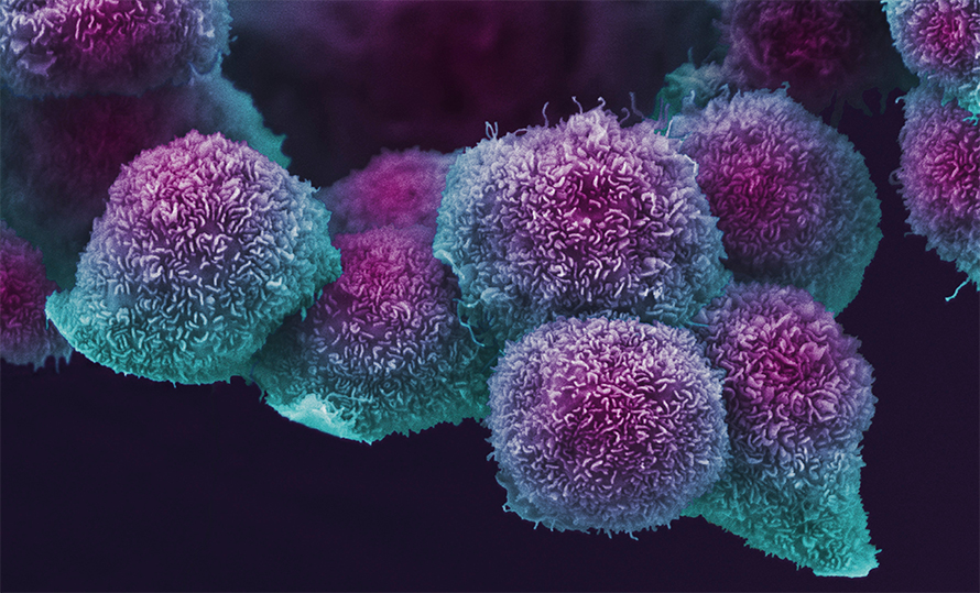 Pancreatic-cancer-cells-890x539.jpg Pancreatic-cancer-cells-890x539.jpg