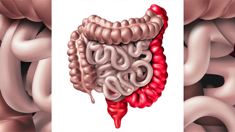 Proteases implicated in ulcerative colitis