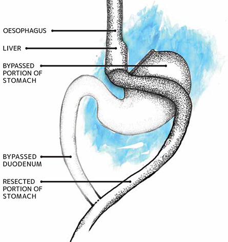 FTJ-JLR-Gastric-bypass-445x471.jpg FTJ-JLR-Gastric-bypass-445x471.jpg