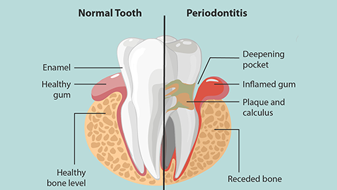 New lipid class may shed light on causes of dental disease