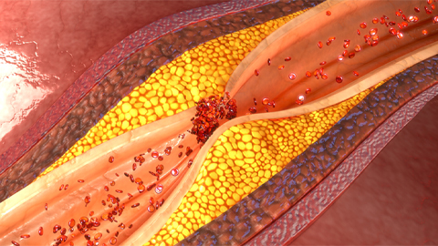 High-fat diet ‘turns up the thermostat’ on atherosclerosis