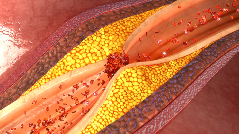 High-fat diet ‘turns up the thermostat’ on atherosclerosis
