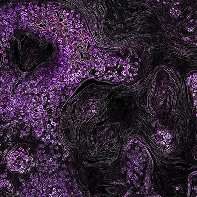 NIHKrasdrivenlungcancer-400x400.jpg NIHKrasdrivenlungcancer-400x400.jpg