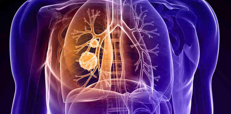 Lung-cancer-776x383.jpg Lung-cancer-776x383.jpg