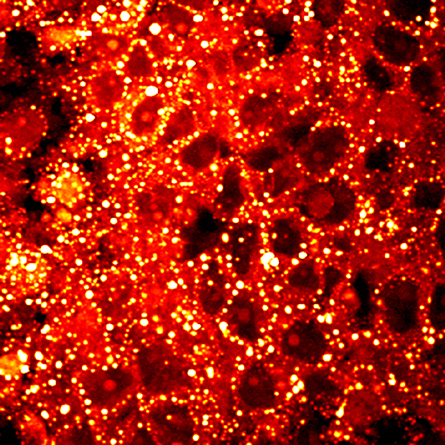 This label-free stimulated Raman scattering image shows the storage of cholesterol ester in lipid droplets (bright dots) in aggressive human prostate cancer.