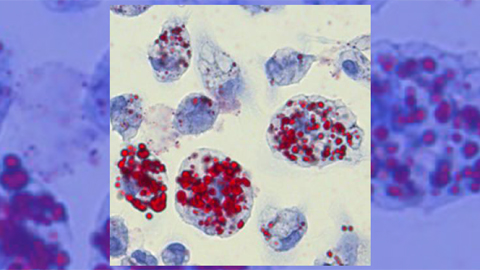 Lipid biomarkers hold clues to stroke recovery