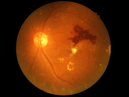 Diabetic-retinopathy-445x336.jpg Diabetic-retinopathy-445x336.jpg