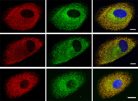 Researchers transduced wild-type cells (top row) and those with mutations that can affect the brain and skin (middle and bottom) with MYC-ELOVL4 constructs, immunostained them for the transcription factor MYC (red) and the endoplasmic reticulum chaperone calnexin (green), then merged them (left column).