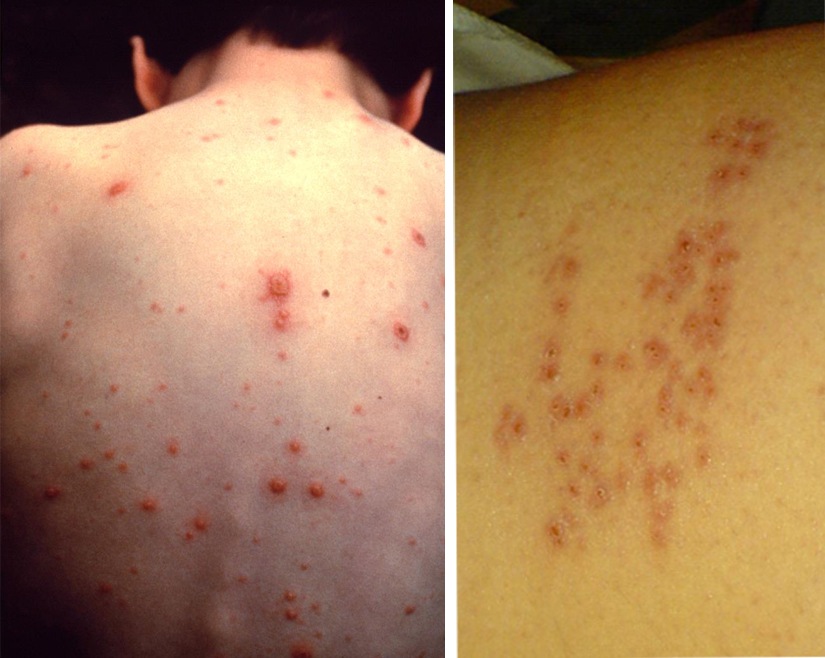 Varicella-825x658.jpg Varicella-825x658.jpg