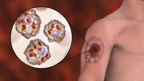 Climate change could fuel the spread of a flesh-eating parasite