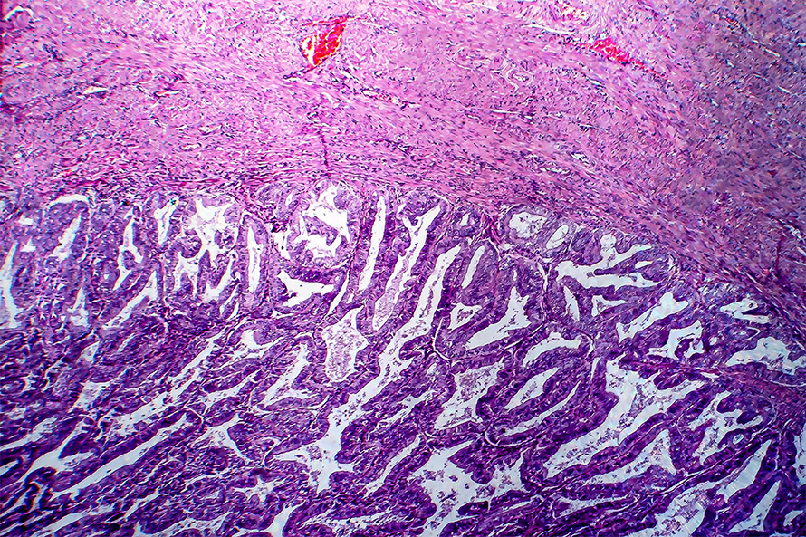 Endometrial-cancer-890x593.jpg Endometrial-cancer-890x593.jpg