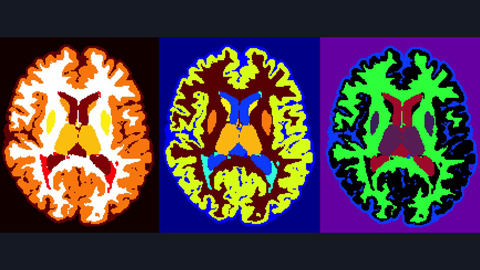 Sphingolipids show potential as biomarkers for multiple sclerosis