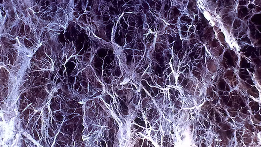 Lung damage from alpha-1 antitrypsin deficiency can lead to emphysema.