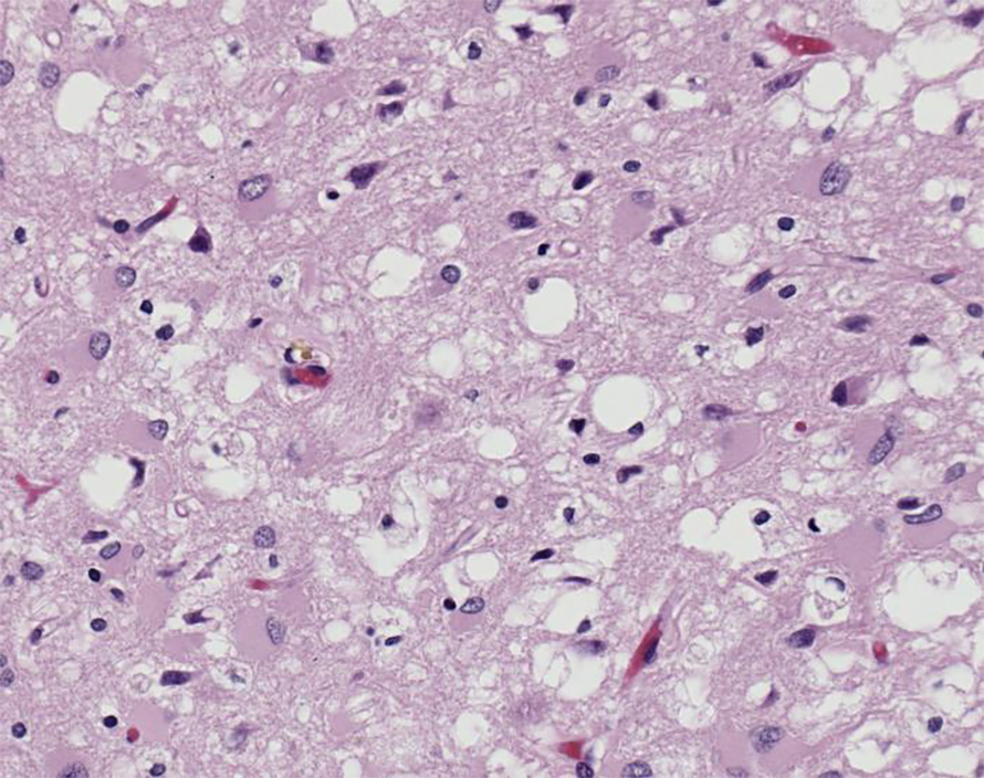 Light microscopy image of brain tissue showing neuronal loss in the brain of a patient with Creutzfeldt–Jakob disease.