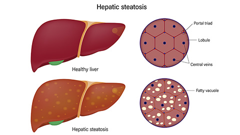 The dual role of asprosin in chronic fatty liver disease