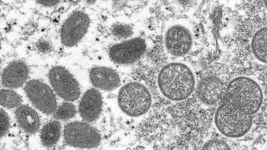 What is Monkeypox?