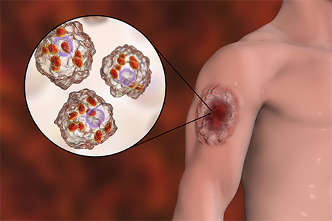 This illustration shows a cutaneous leishmaniasis ulcer and a close-up view of Leishmania amastigote–infected human histiocyte cells.