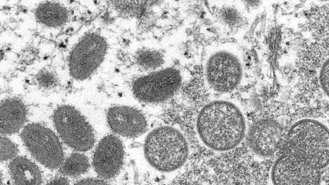 What is monkeypox?