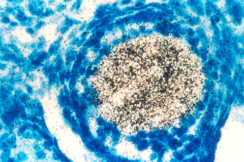 Expression of oncogenes in cells downregulates antiviral pathways and type 1 interferon pathway proteins.