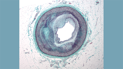 JLR: Arteries and bacterial lipids don’t mix