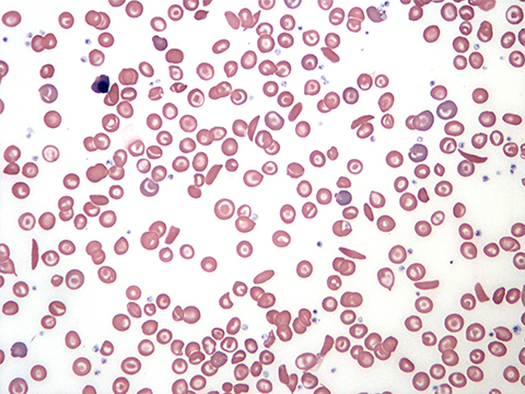 Microscopy image of a blood smear from a patient with sickle cell disease.