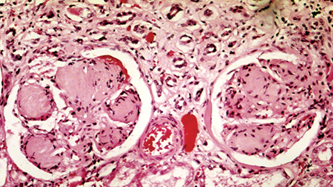 MCP: Tracing damage pathways in diabetic kidney disease