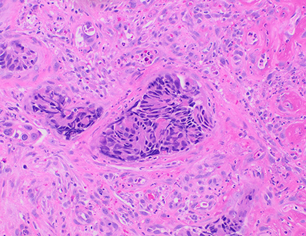 Histopathology of colorectal adenocarcinoma with lymphatic invasion.